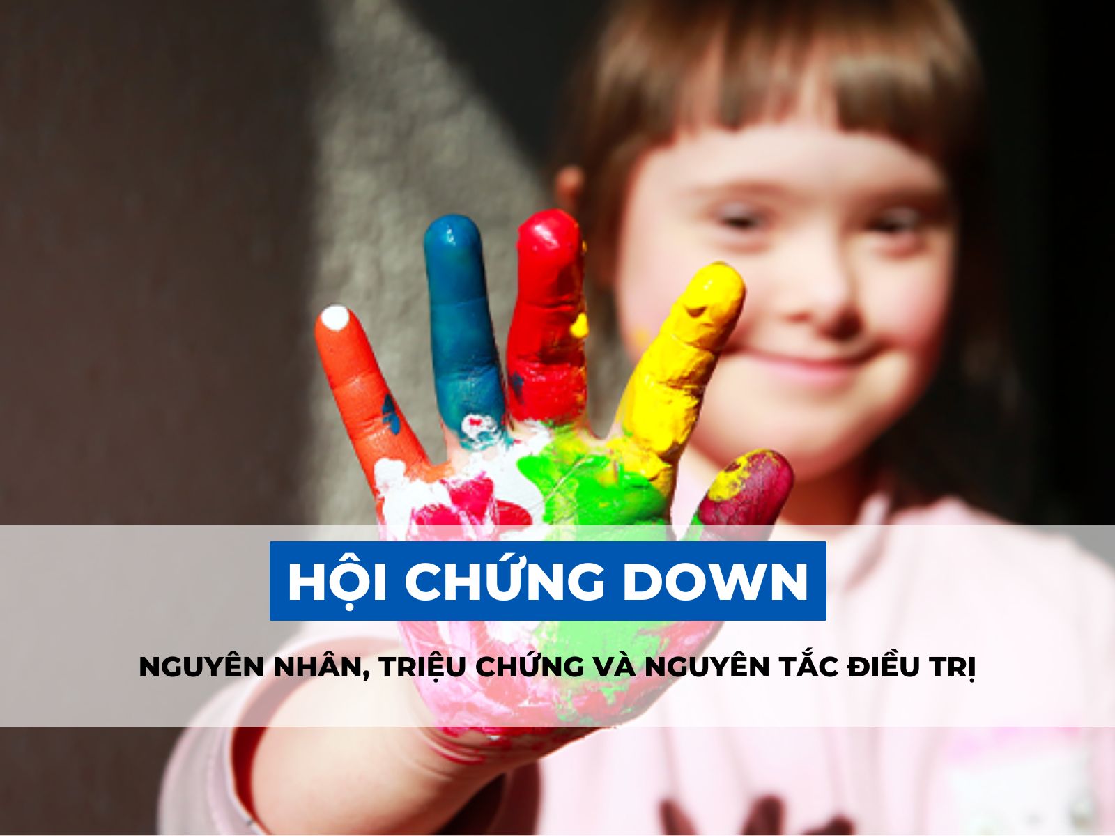 hội chứng down