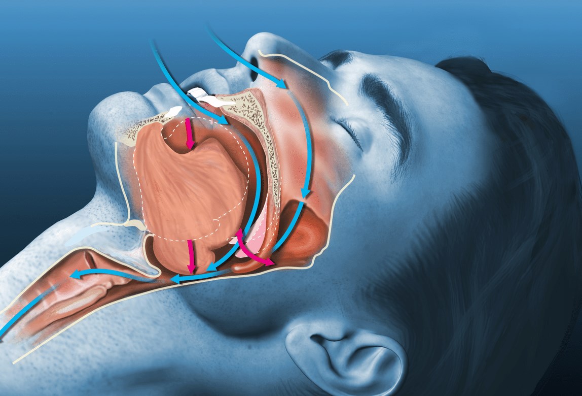 nguyên nhân hội chứng ngưng thở khi ngủ