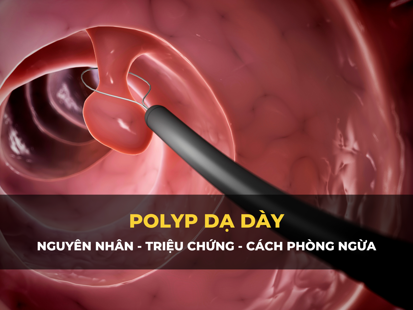 polyp dạ dày