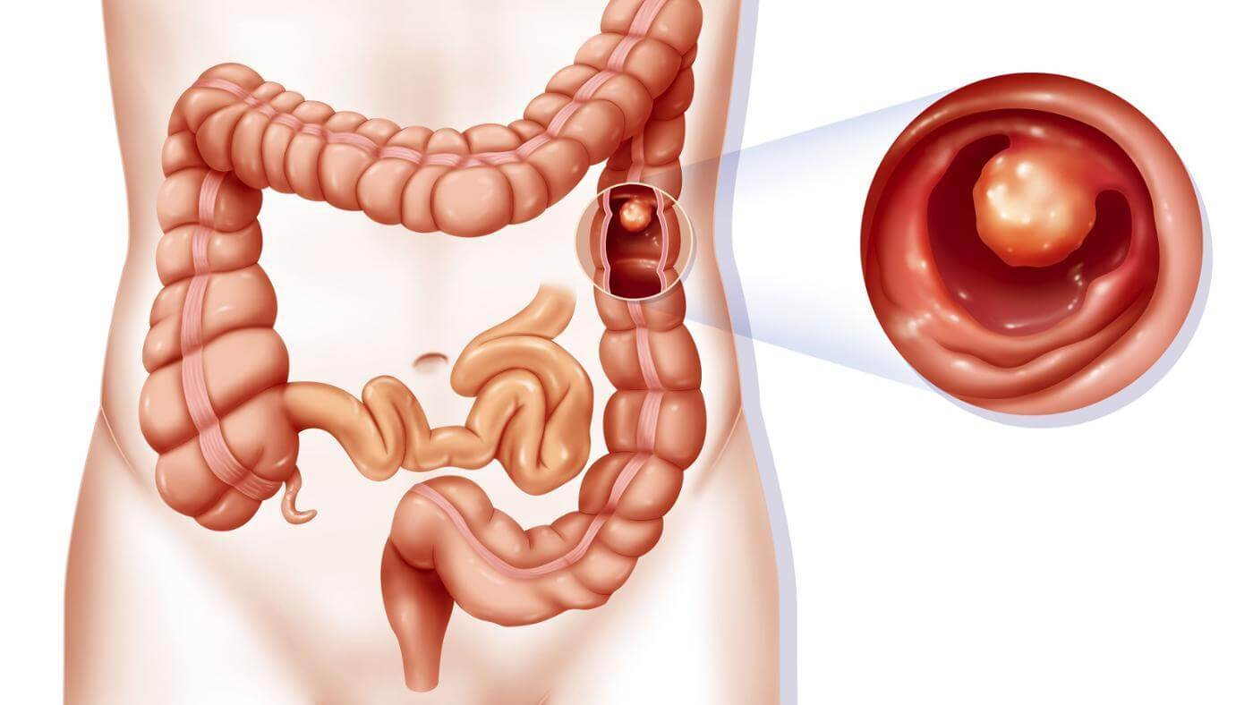 nguyên nhân bệnh polyp dạ dày